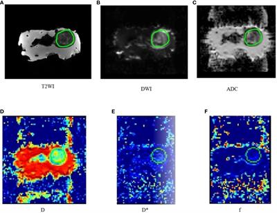 Assessment of chemotherapy resistance changes in human colorectal cancer xenografts in rats based on MRI histogram features